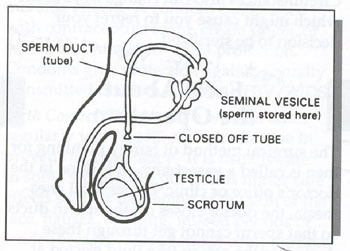 Illustration showing the location of the sperm duct (tube), seminal vesicle (where sperm is stored), the closed off tube of a vasectomy, the testicle, and the scrotum.